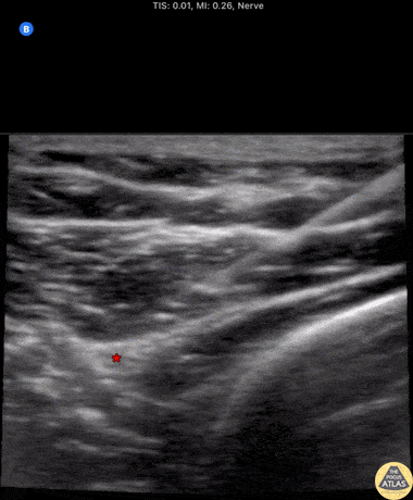 Nerve Block Gallery - Radial Nerve Block at the Elbow