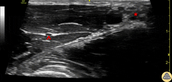 Nerve Block Gallery - Axillary Brachial Plexus Anatomy