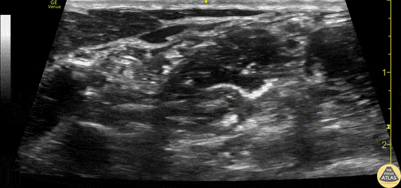 Nerve Block Gallery - Interscalene Brachial Plexus Anatomy
