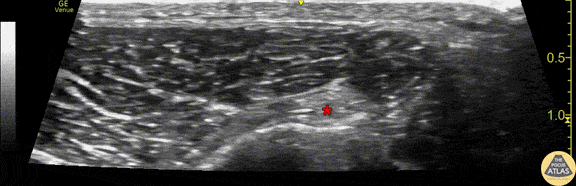 Nerve Block Gallery - Common Peroneal Nerve Anatomy