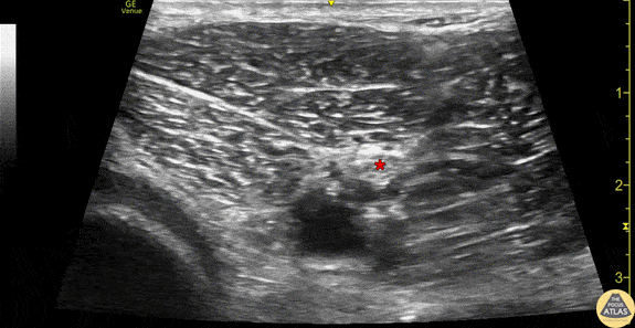 Nerve Block Gallery - Sciatic Nerve Anatomy