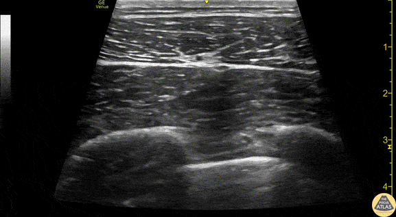 Nerve Block Gallery - Serratus Anterior Anatomy