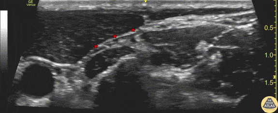 Nerve Block Gallery - Superficial Cervical Plexus Anatomy