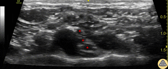 Nerve Block Gallery - Supraclavicular Brachial Plexus Anatomy