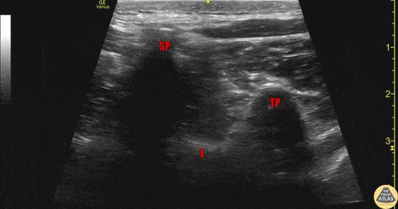 Nerve Block Gallery - Thoracic Vertebral Anatomy