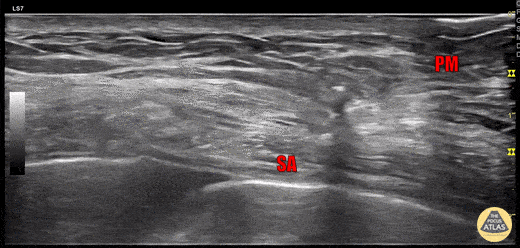 Nerve Block Gallery - Serratus Anterior Plane Block 2