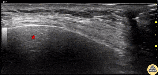Nerve Block Gallery - Sub-Serratus Anterior Plane Block