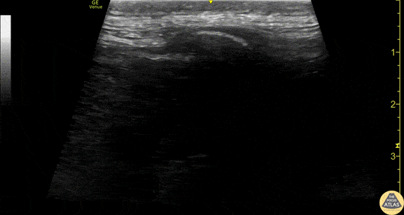 Nerve Block Gallery - Erector Spinae Anatomy Scan