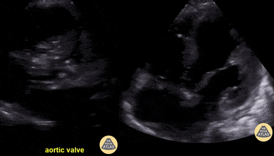 Valvulopathy - Infective Endocarditis