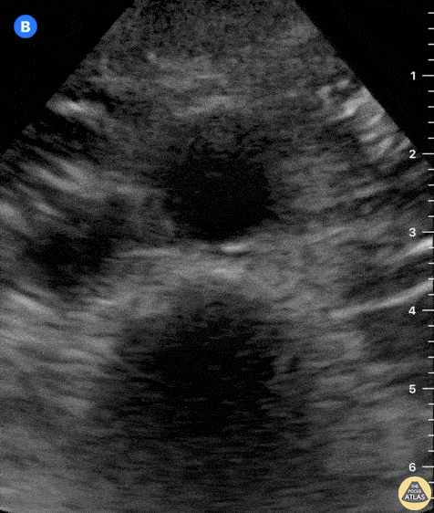 Aorta - Normal Aorta & Iliac Arteries - Transverse