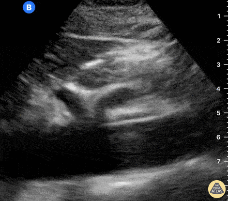 Aorta - Normal Celiac Trunk & SMA - Longitudinal