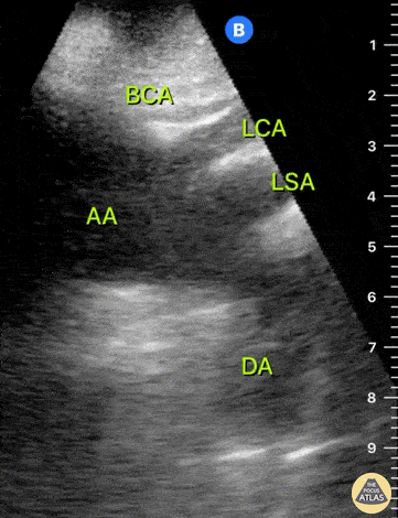 Aorta - Normal Aortic Arch - Suprasternal View