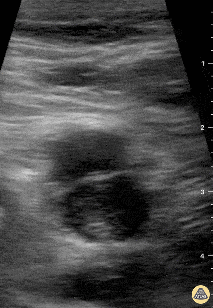 Vascular - Right Femoral DVT
