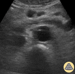 Aorta - Aortic Dissection Flap