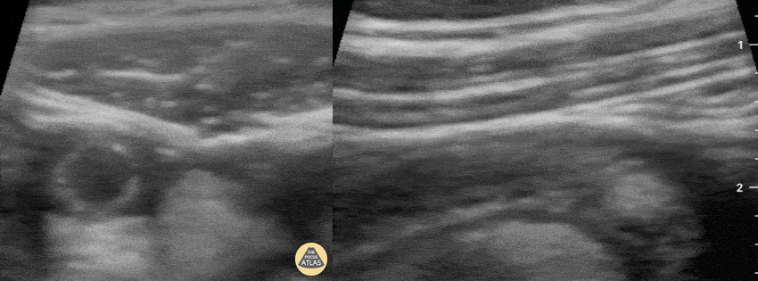 Pediatrics - Acute Appendicitis