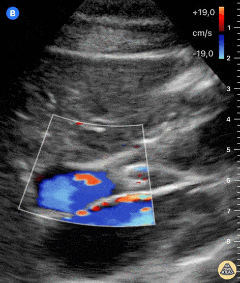 Biliary - Normal Portal Triad - Doppler