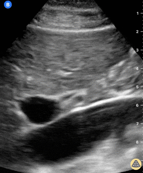 Biliary - Normal Portal Triad without Doppler