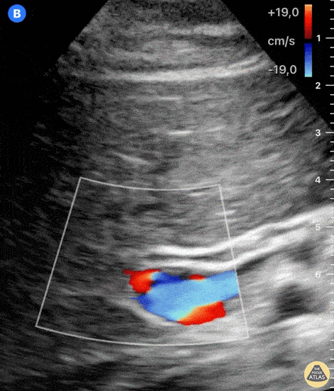 Biliary - Normal Common Bile Duct