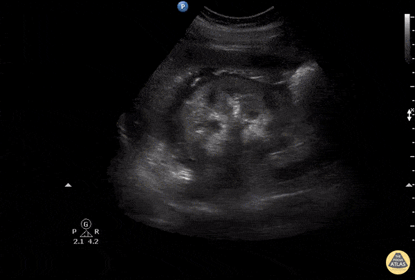 Renal/GU - Calyceal Rupture