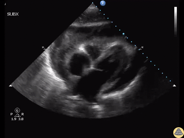 Pericardial Disease - Purulent Pericarditis