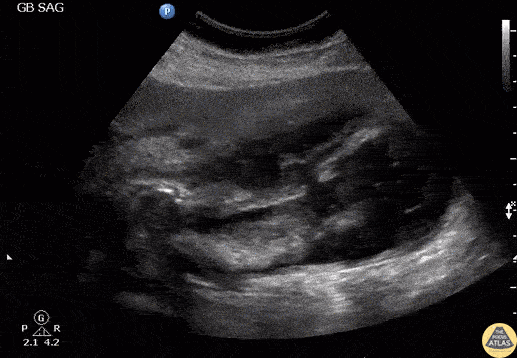 Biliary - Cholecystitis with Gallbladder Rupture
