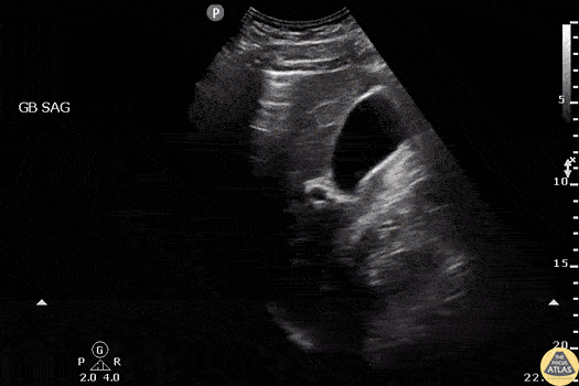 Bowel-GI - Pneumoperitoneum
