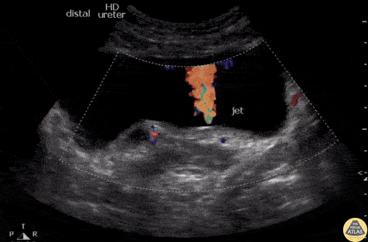 Renal/GU - Right Distal Ureterovesicular Junction Stone