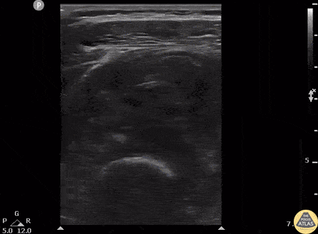 Musculoskeletal - Myositis Ossificans