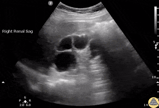 Renal/GU - Xanthogranulomatous Pyelonephritis