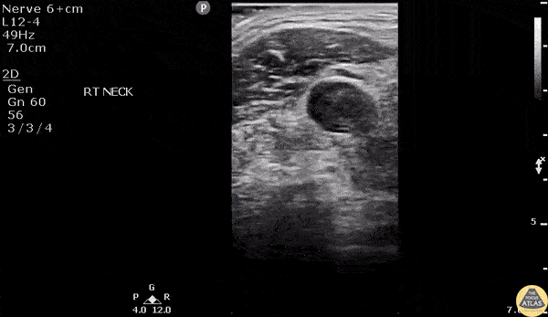 Vascular - Lemierre Syndrome