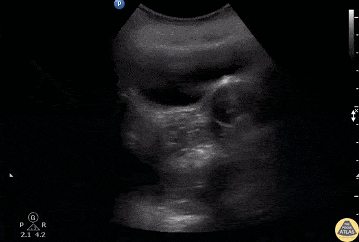 OB/Gyn - Left Ovarian Cyst