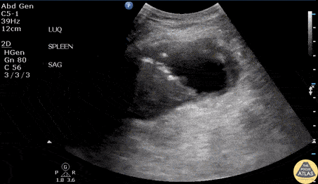 Bowel-GI - Splenic Abscess