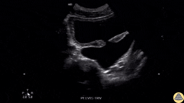 Renal/GU - Bladder Diverticulum