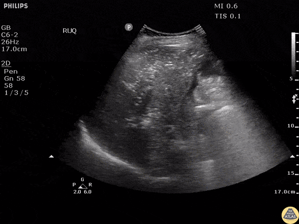 Bowel-GI - Portal Venous Gas