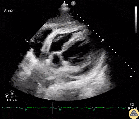 Pericardial Disease - Constrictive Pericarditis