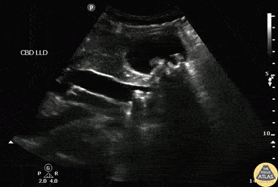 Biliary - Choledocolithiasis