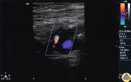 Vascular - AV Fistula