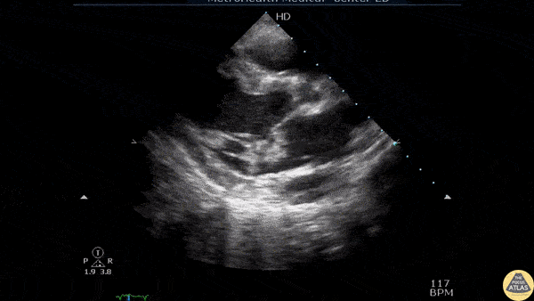 Valvulopathy - Mitral Valve Endocarditis
