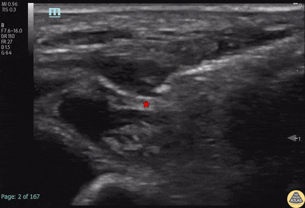Nerve Block Gallery - Neonatal Fascia Iliaca Block