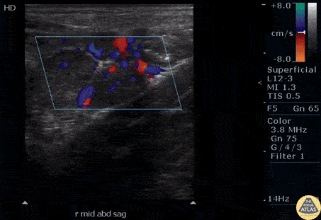 Bowel-GI - Mesenteric Adenitis