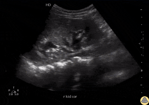 Renal/GU - Ureteropelvic Junction Stone