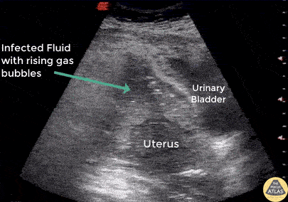 OB/Gyn - Uterine Perforation