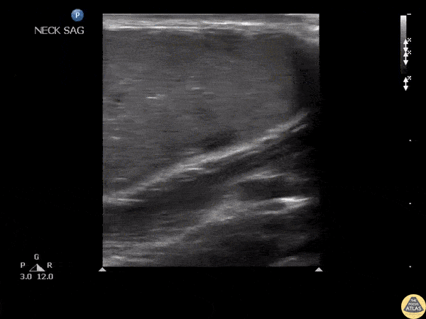 Soft Tissue - Epidermoid Cyst