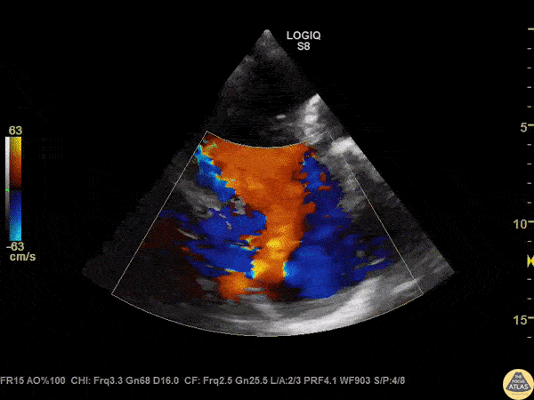 Valvulopathy - Tricuspid Regurgitation