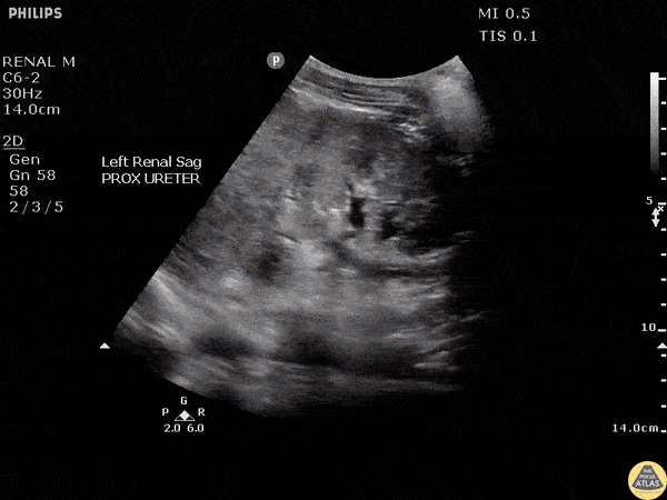 Renal/GU - Urothelial Thickening