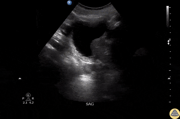 Renal/GU - Misplaced Foley