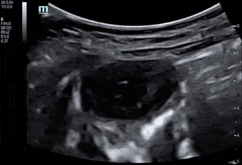 Bowel-GI - Ruptured Appendix with Abscess Formation