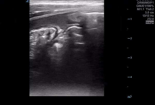 Bowel-GI - Ruptured Appendicitis with Intraabdominal Free Fluid