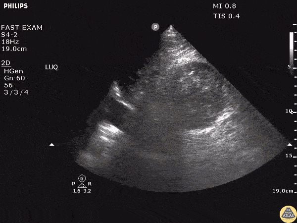 Trauma - Retroperitoneal Hematoma