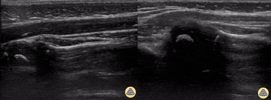Pediatrics - Nursemaid's Elbow